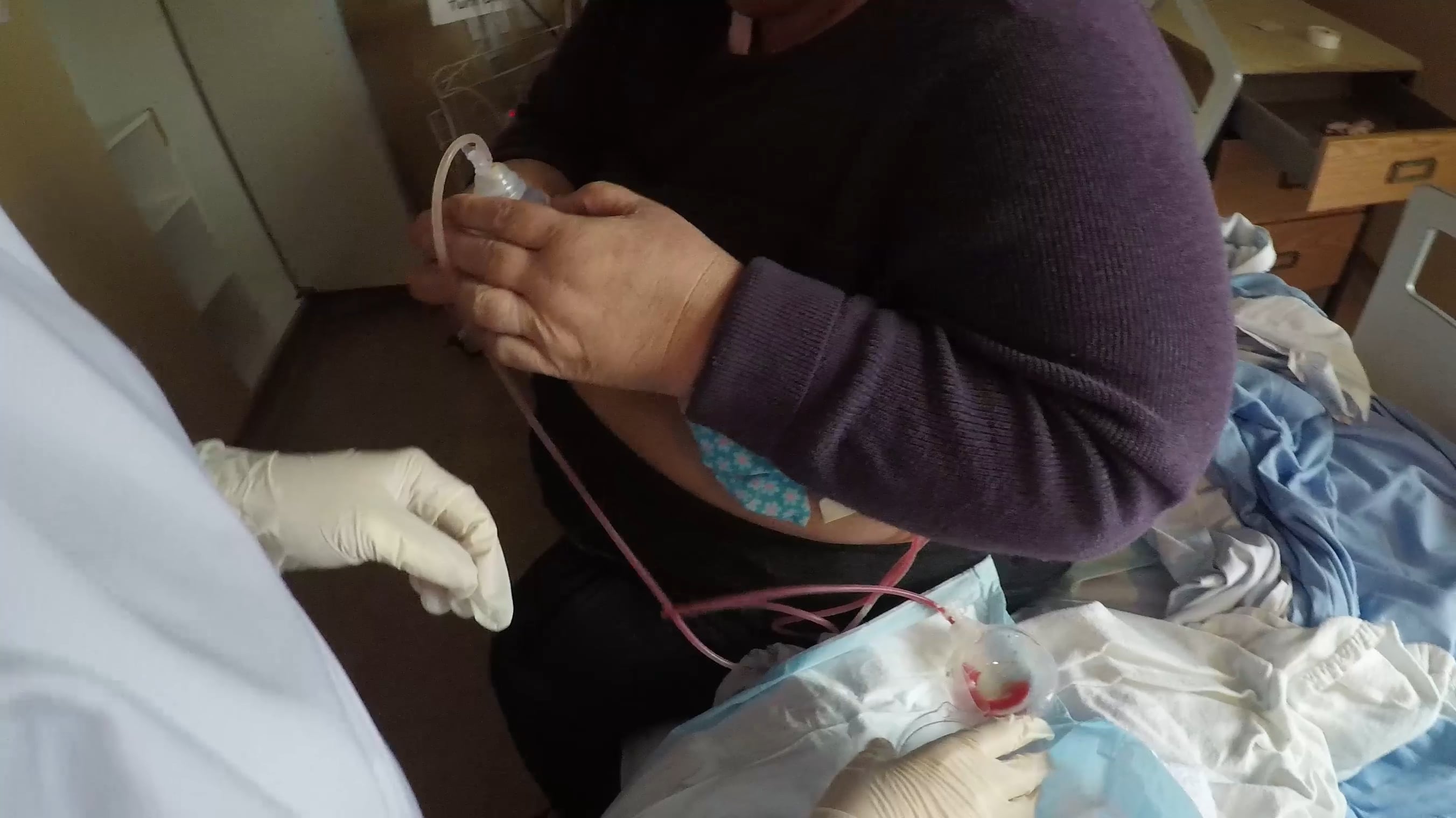 Learning how to empty the Surgical Drains after a Mastectomy on Vimeo