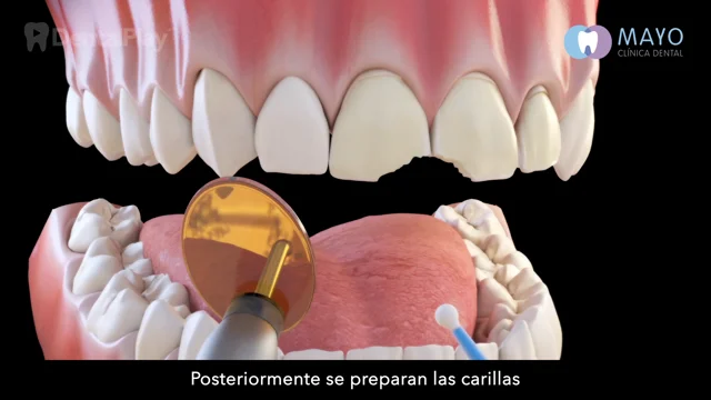 Cómo es el tratamiento de carillas dentales - Clínica Pfaff