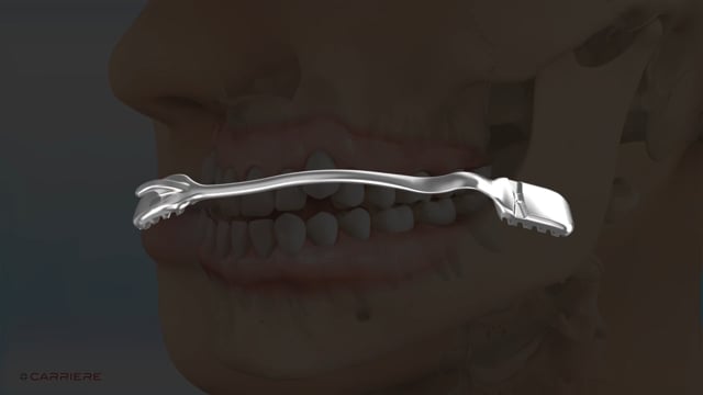 Carriere Motion CLASS Ⅲ（下顎前突用）
