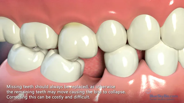 Tooth Gems – Triple Crown Dentistry
