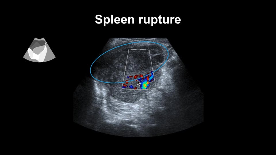 Spleen: Evaluation of the spleen in trauma