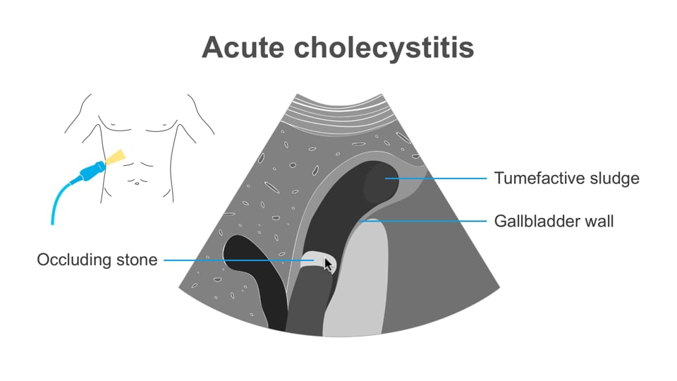 Biliary system: Evaluation the gallbladder and cholecystitis