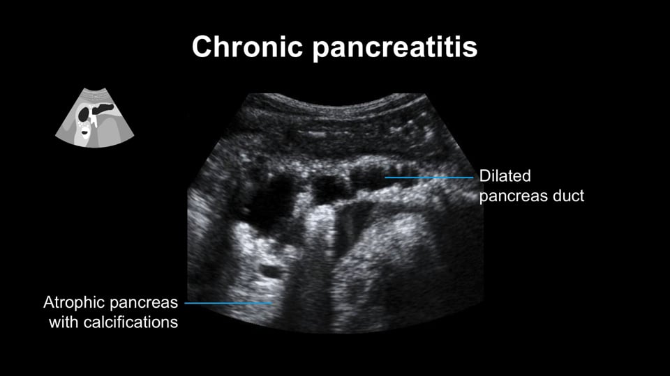Pancreas: Diagnosing pancreatitis