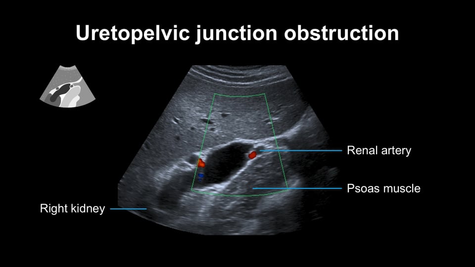 Renal ultrasound: Hydronephrosis