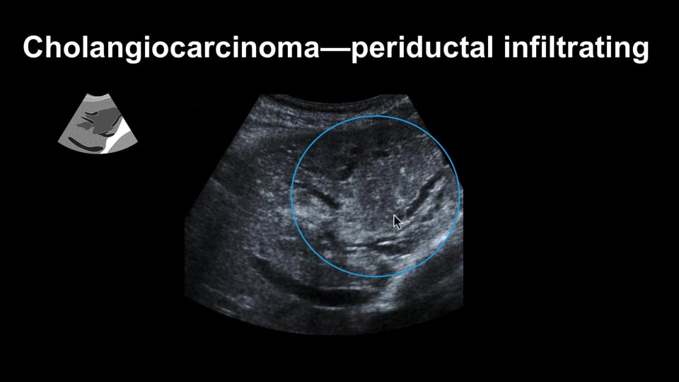 Liver Ultrasound: Detecting focal malignant lesions