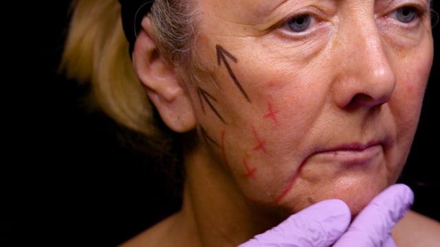 Facial Sagging Injections