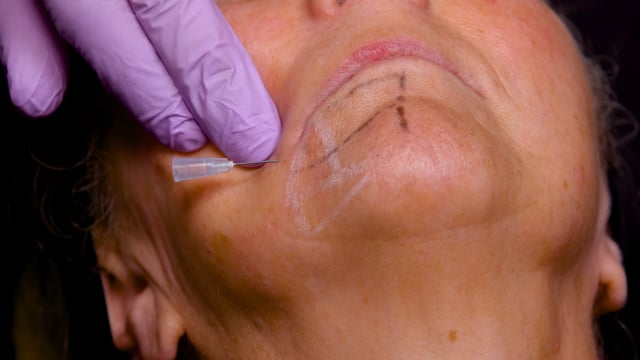 Chin pre jowl and marionette treatment
