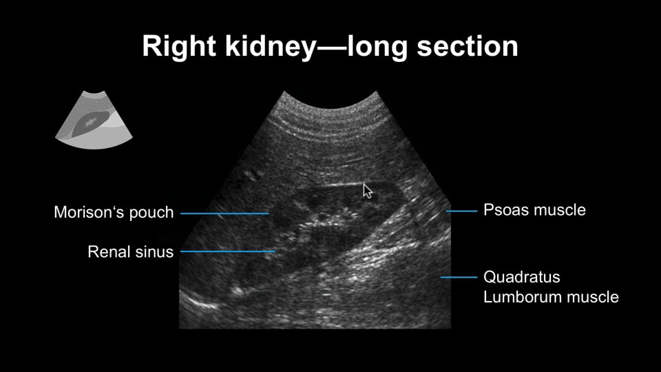 Renal Ultrasound