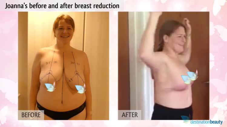 Joanna's Before & After Beast Reduction on Vimeo