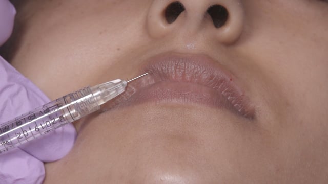 Dermal Fillers: Lip Asymmetry & Retrusive Chin - 