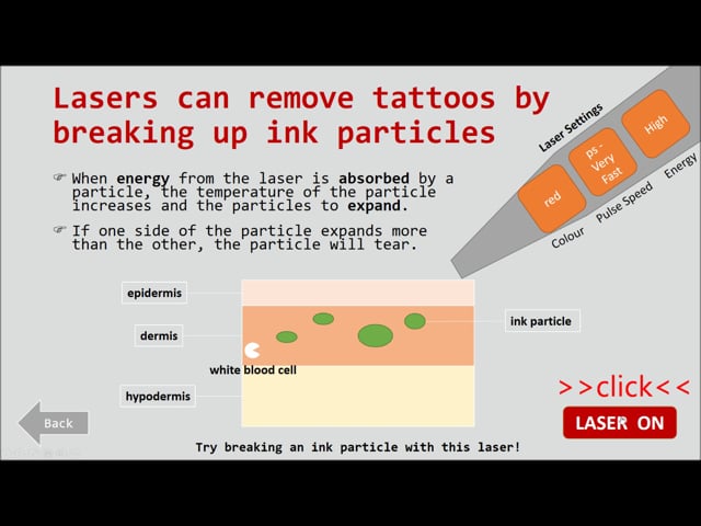 Laser Tattoo Removal