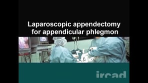 Laparoscopic appendectomy for appendicular phlegmon | WebSurg, the ...
