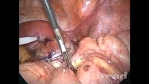 Dor Abdominal Aguda Em Paciente Feminina Jovem Com Cisto Endometrial E Apendicite Aguda Websurg The Online University Of Ircad