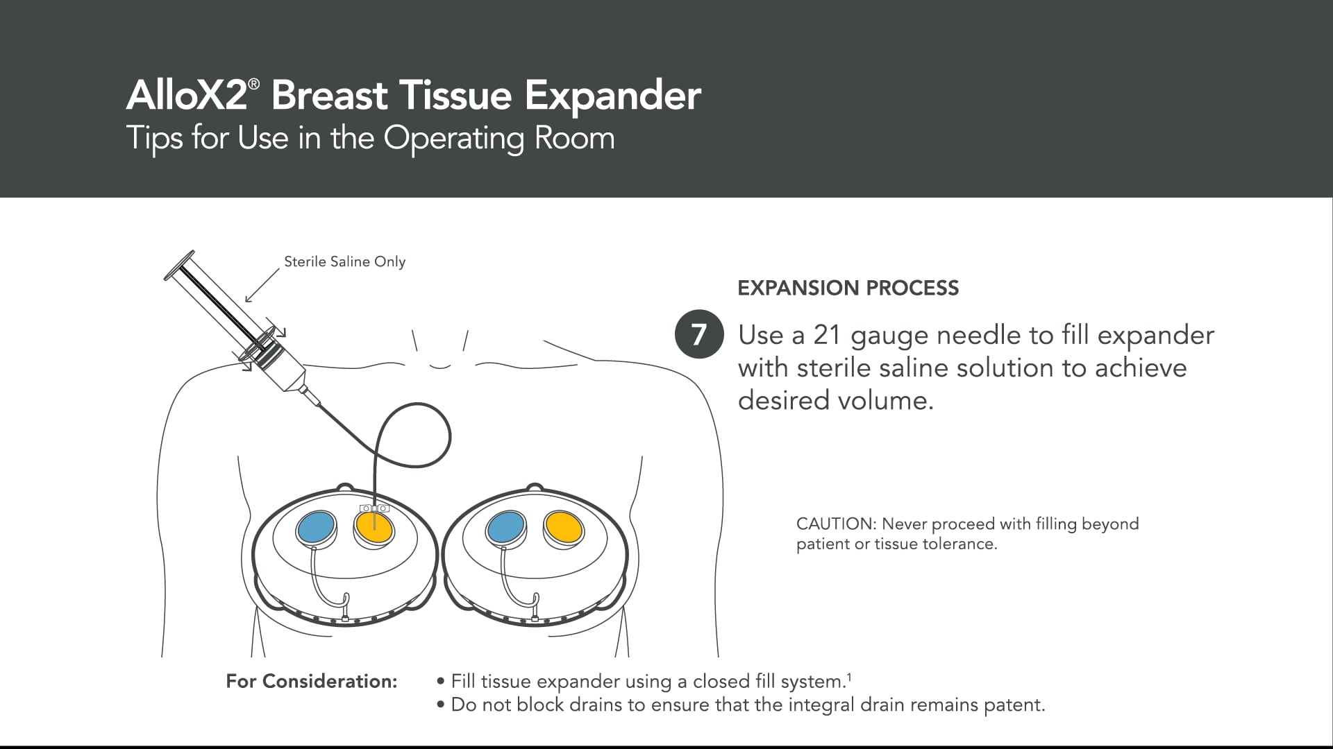 Sientra AlloX2(R) Breast Tissue Expander - Tips for the Operating Room