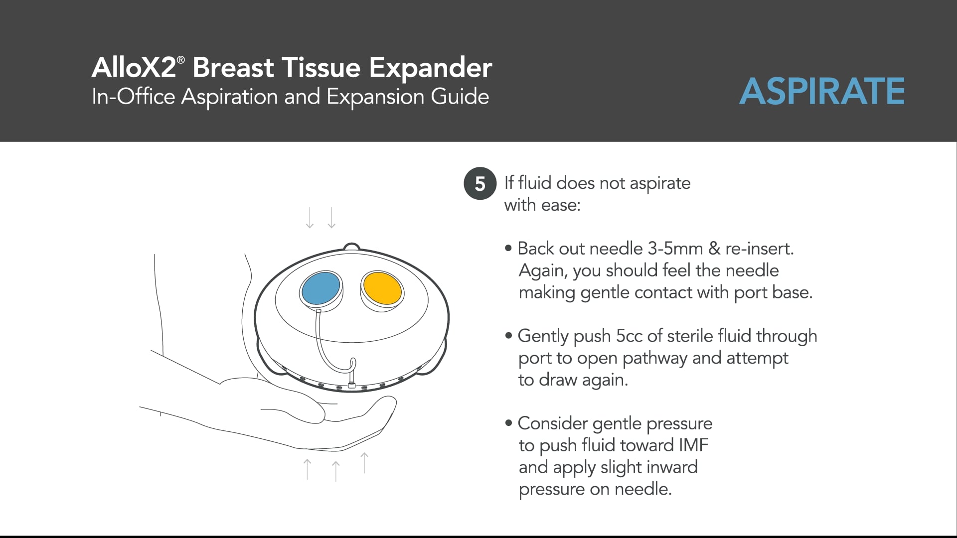 Sientra AlloX2(R) Breast Tissue Expander - In Office Aspiration Guide