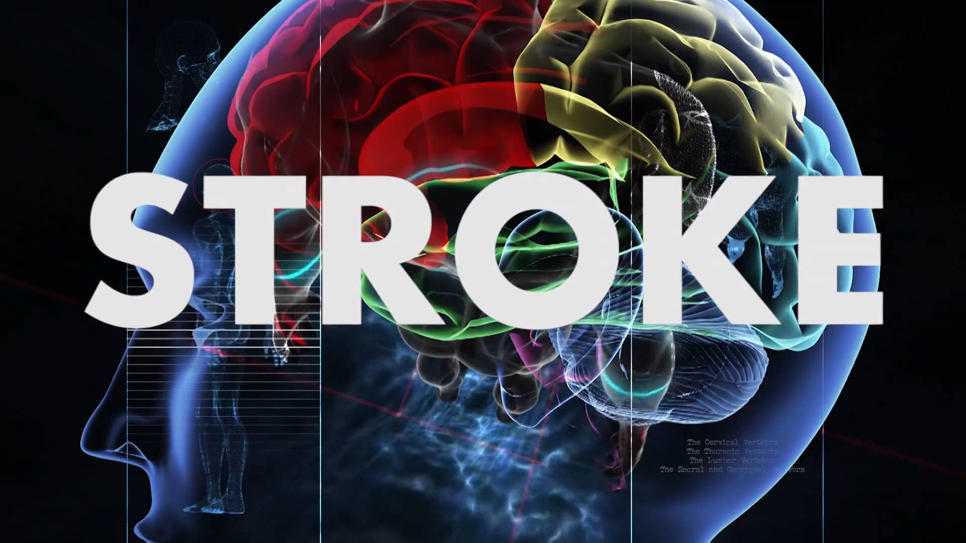 Treatment for Strokes on Vimeo