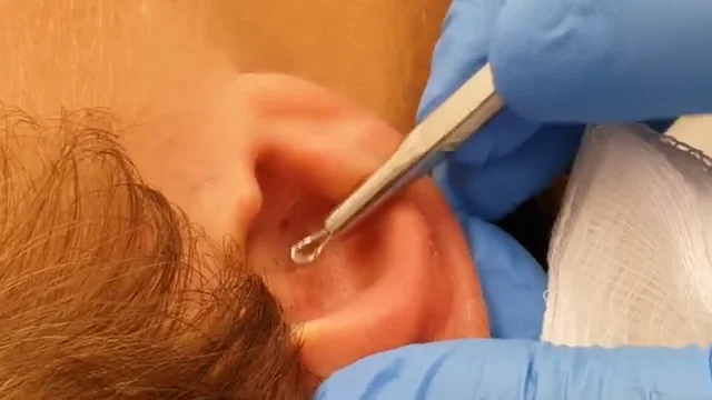 Как убрать черные точки в ушах?