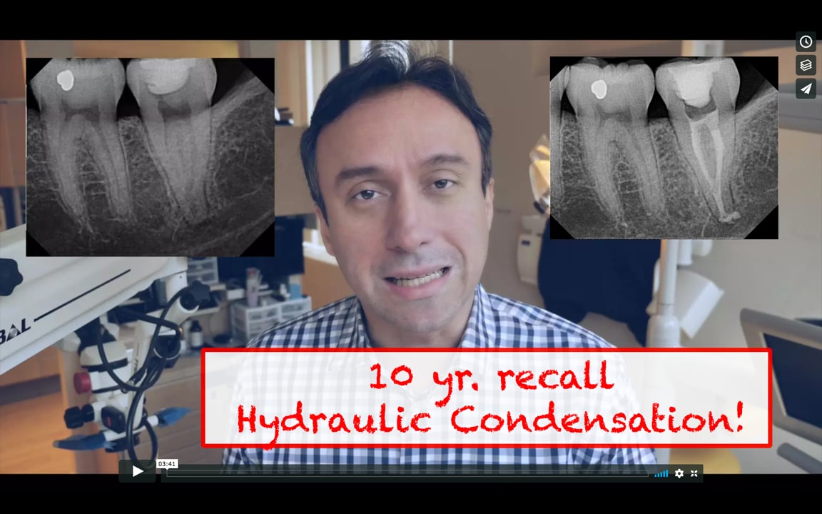 CBL29 A 10 yr. recall of Hydraulic Condensation Real World Endo
