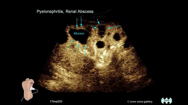 Pyelonephritis, Renal Abscess