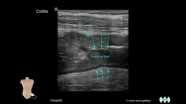 Colitis