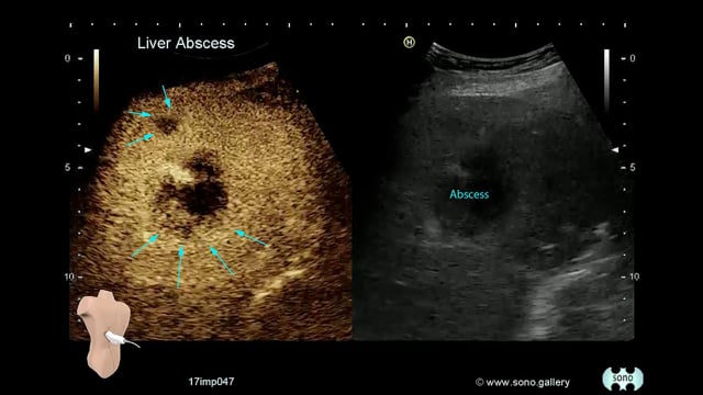 Liver Abscess