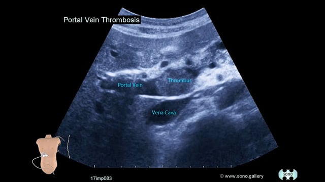 Portal Vein Thrombosis