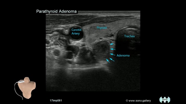 Parathyroid Adenoma
