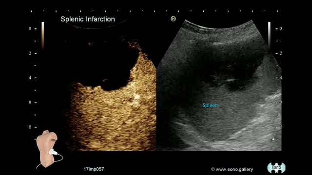 Splenic Infarction