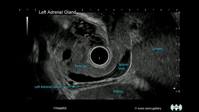Left Adrenal Gland