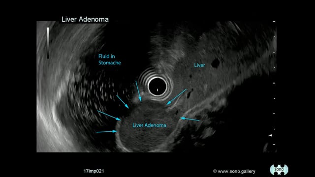 Liver Adenoma