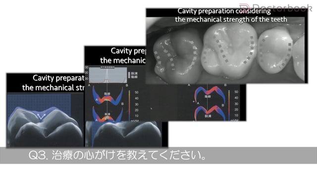 ダイレクトボンディングを用いた虫歯治療