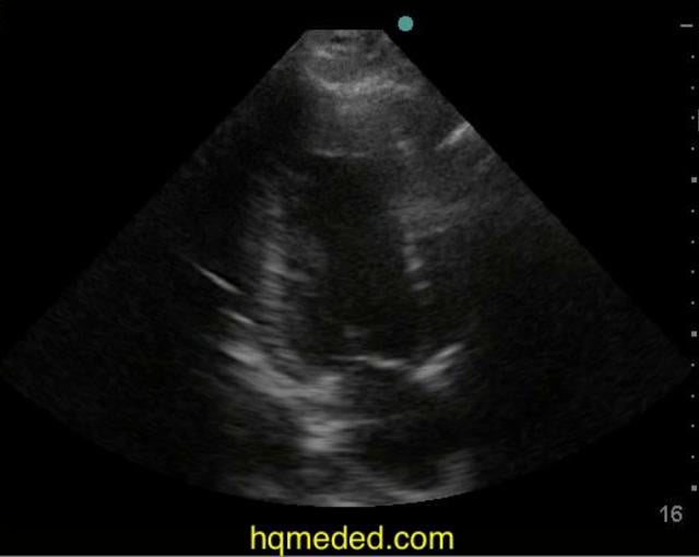 Ultrasonography - acute inferior MI on Vimeo