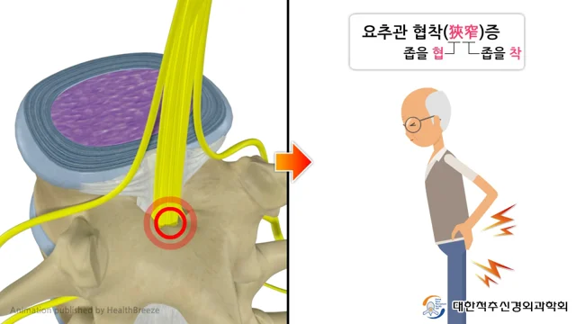 허리협착증,목협착증,경주,경산,밀양,사천,거제,통영,창원,마산,양산,현장재활운동으로 고민이시라면