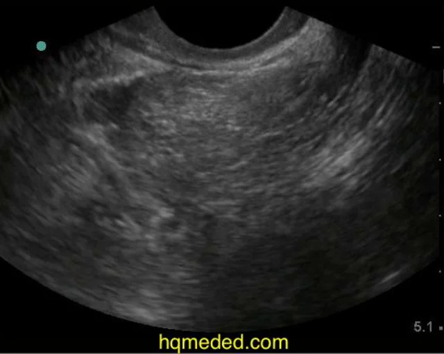 Ultrasonography free fluid in pelvis on Vimeo