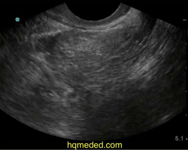 Ultrasonography - free fluid in pelvis on Vimeo