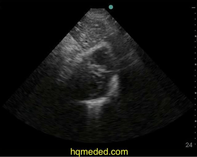 Ultrasonography - sepsis, dry, collapsing IVC on Vimeo