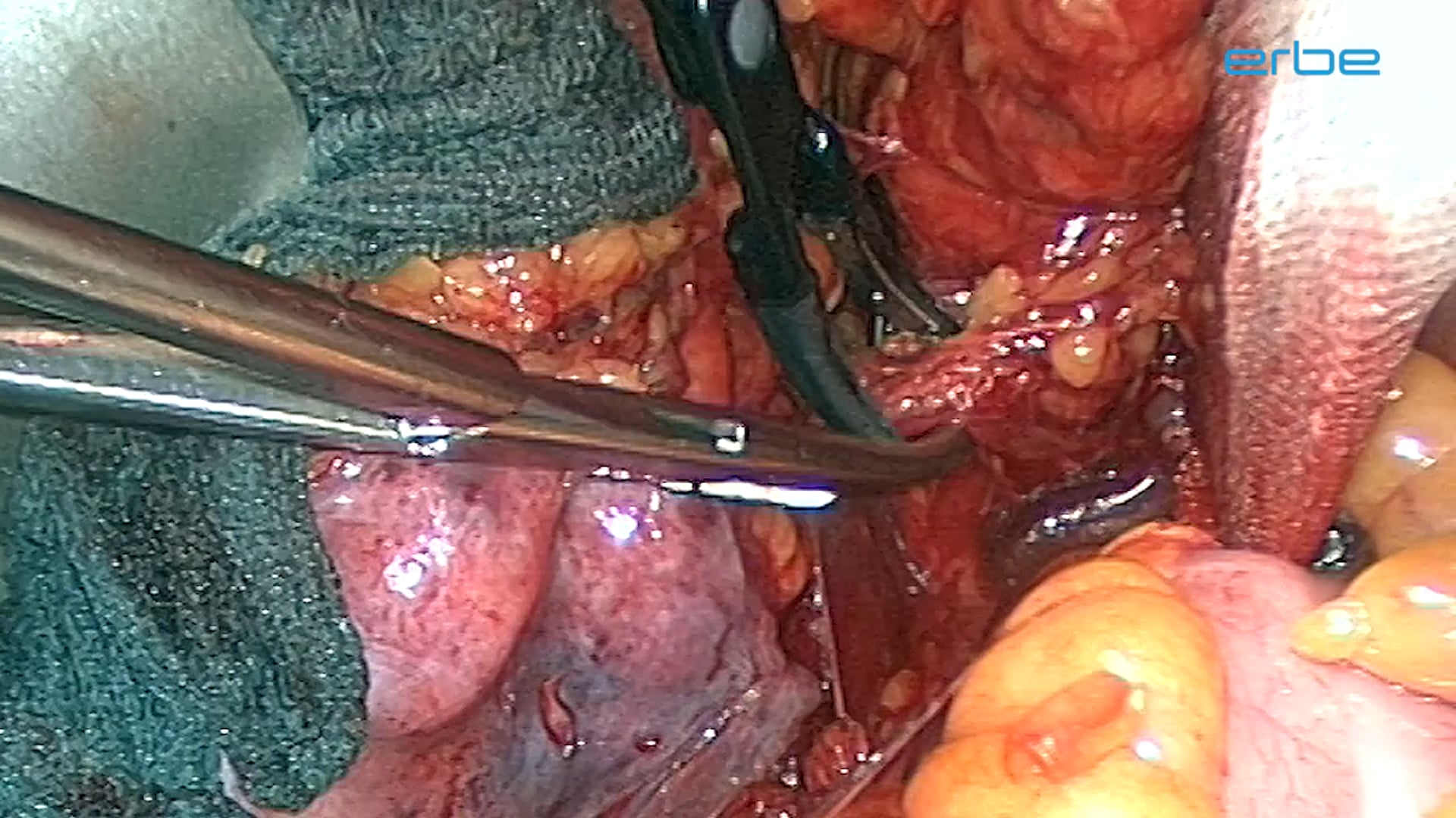 Radical cystectomy and formation of a neobladder in female patients with BiClamp®