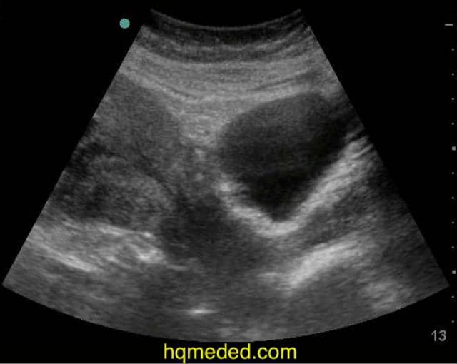 IUP 11 weeks subchorionic hemorrhage on Vimeo