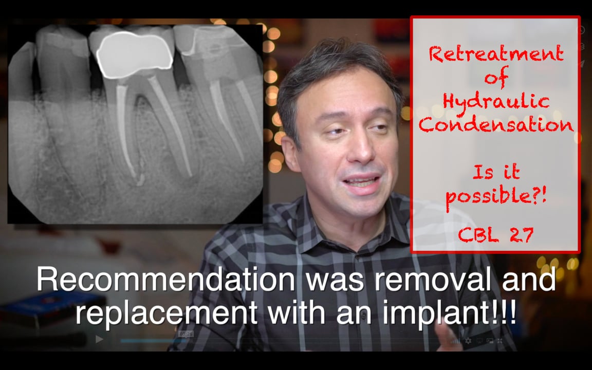 Retreatment of Hydraulic Condensation with BC Sealer (CBL 28) Real