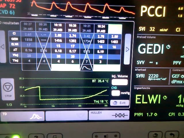 PICCO - Mitral Valve Insufficiency TPTD on Vimeo