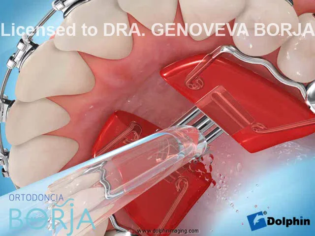 Ortodoncia Borja  Un salvavidas llamado férula. Información sobre