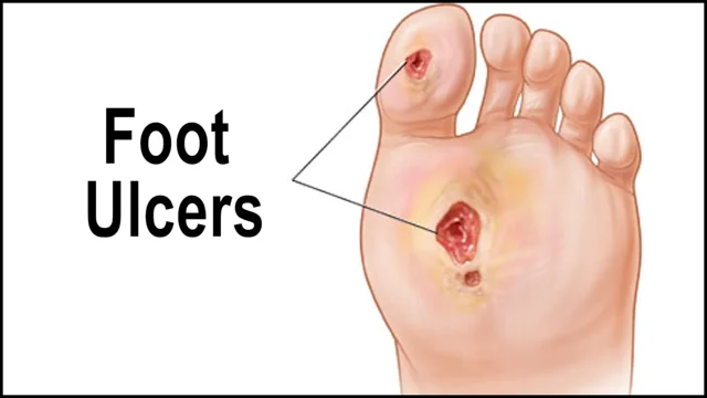 diabetic foot ulcer stages