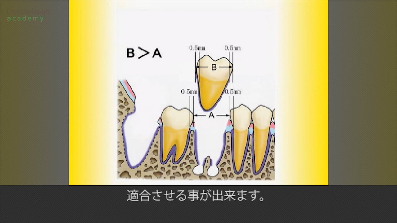 月星光博先生による自家歯牙移植〜ライブオペ〜