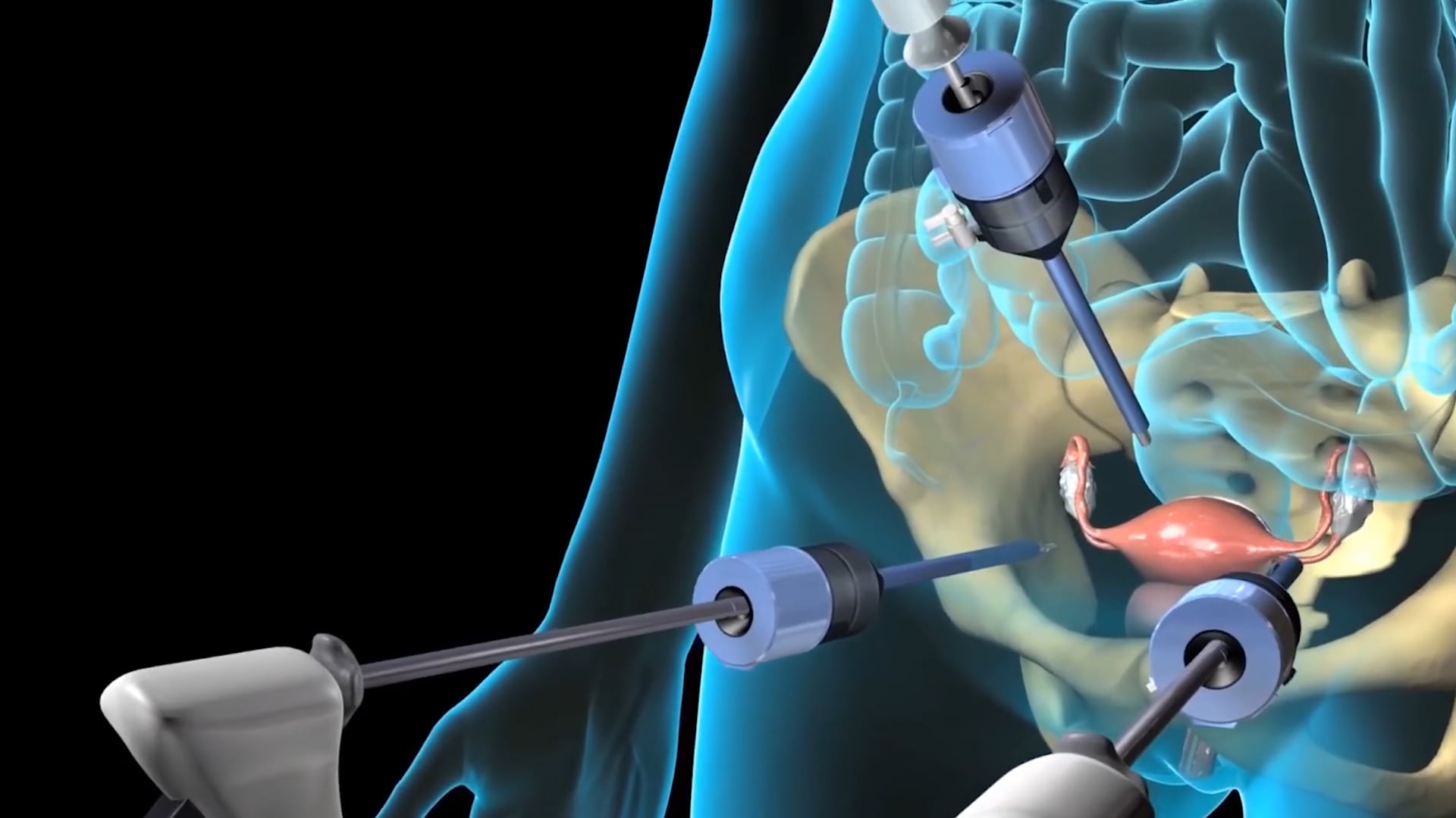 Choosing Laparoscopic Surgery for Gynaecology