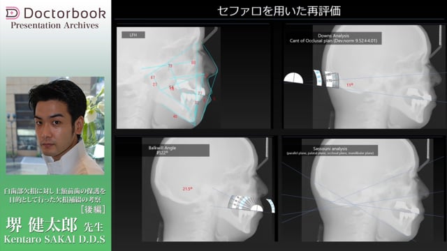 臼歯部欠損に対し上顎前歯の保護を目的として行った欠損補綴の考察（後編）