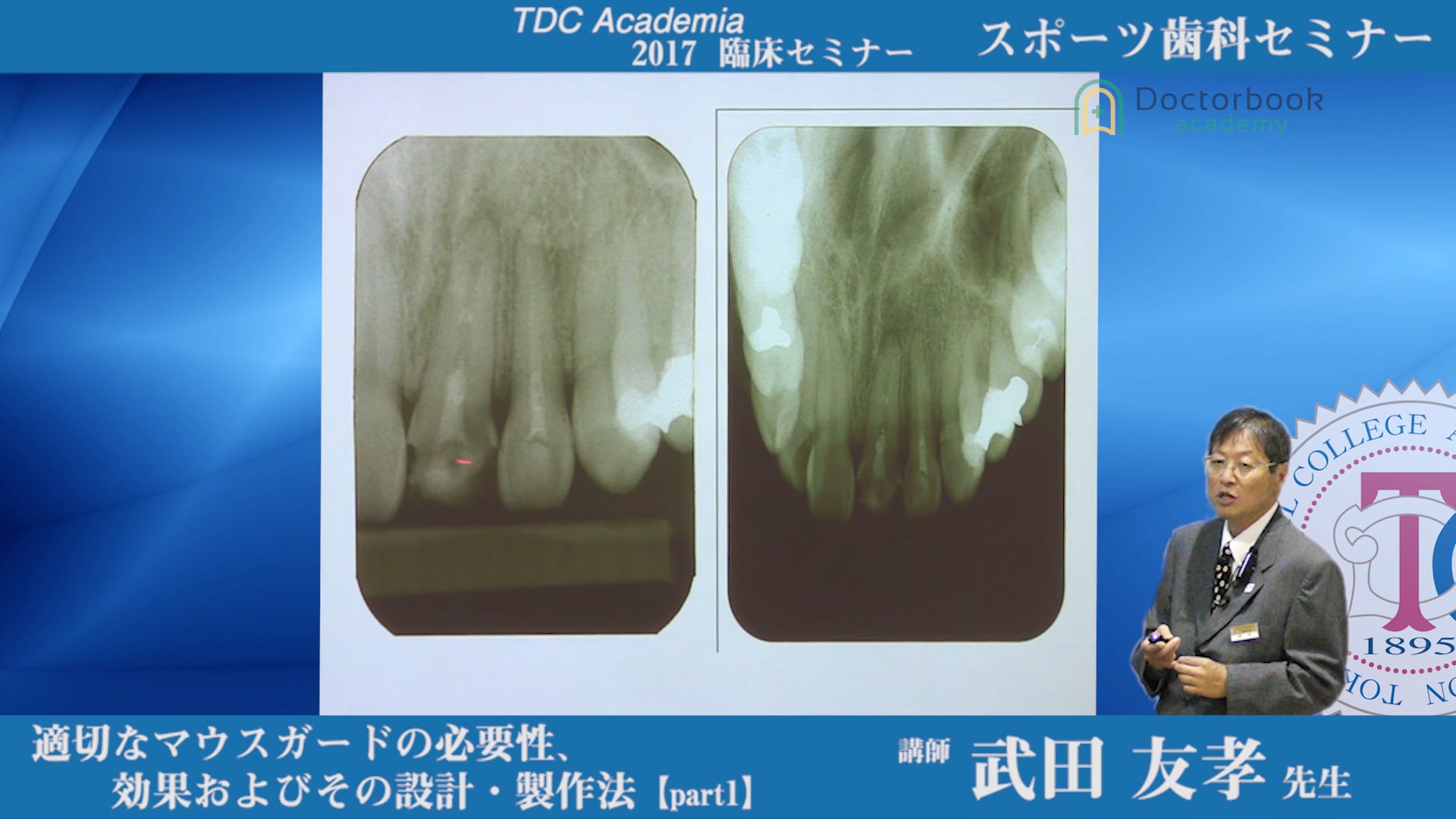 適切なマウスガードの必要性・効果およびその設計・制作法 #1