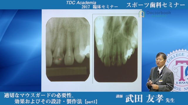 適切なマウスガードの必要性・効果およびその設計・制作法