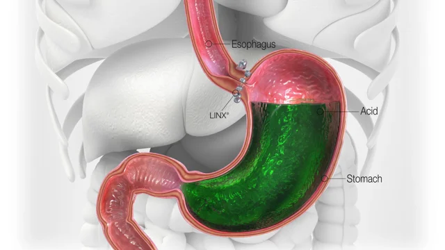 lower esophageal sphincter repair