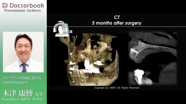 インプラント治療におけるGuided Surgery