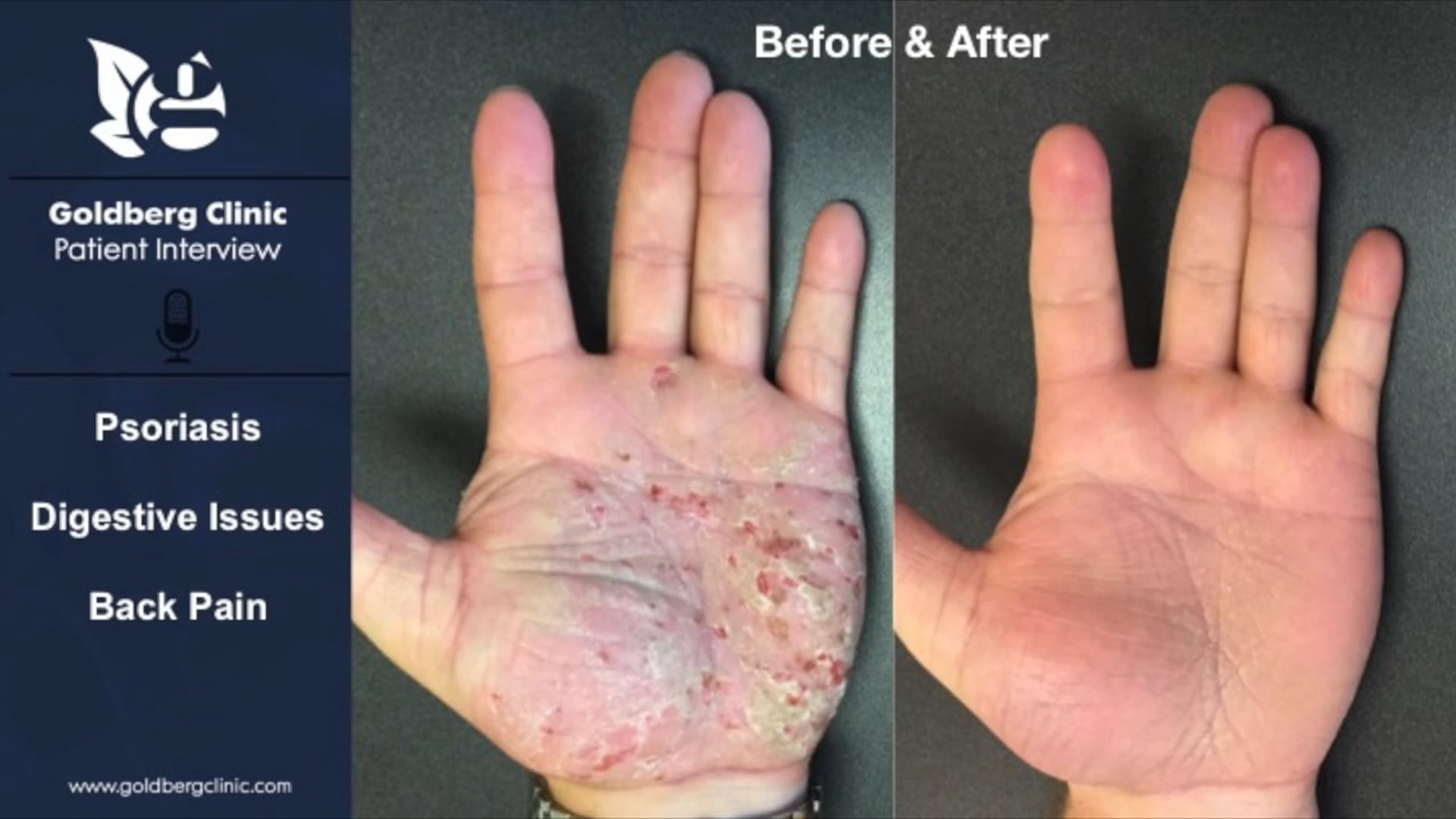 Reversing Psoriasis, Digestive Issues, Back Pain